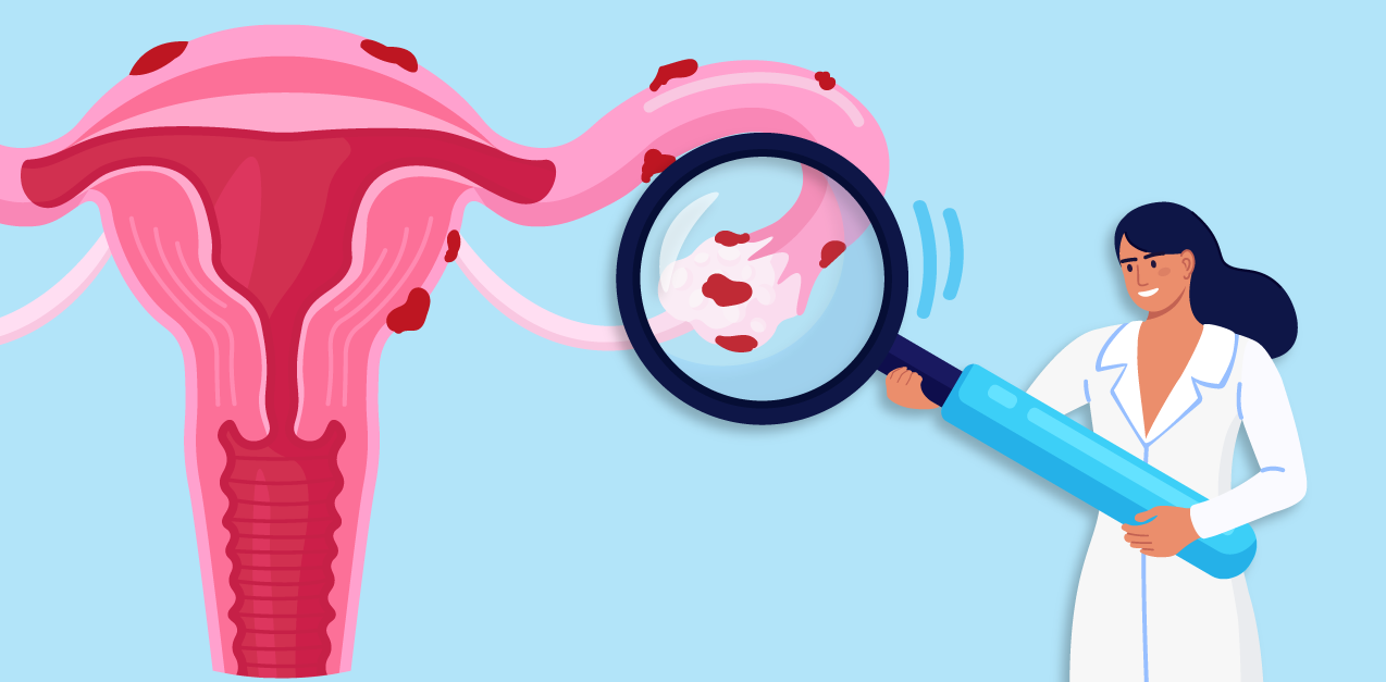 Endometriosis-y-la-busqueda-del-embarazo