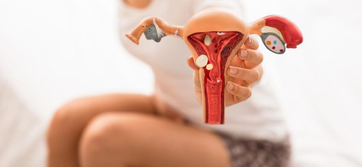 endometriosis